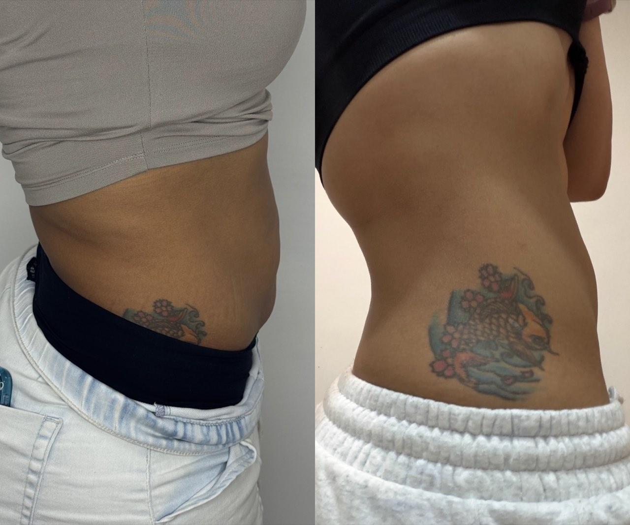Before and after photo of a NuGen patient — Body contouring
