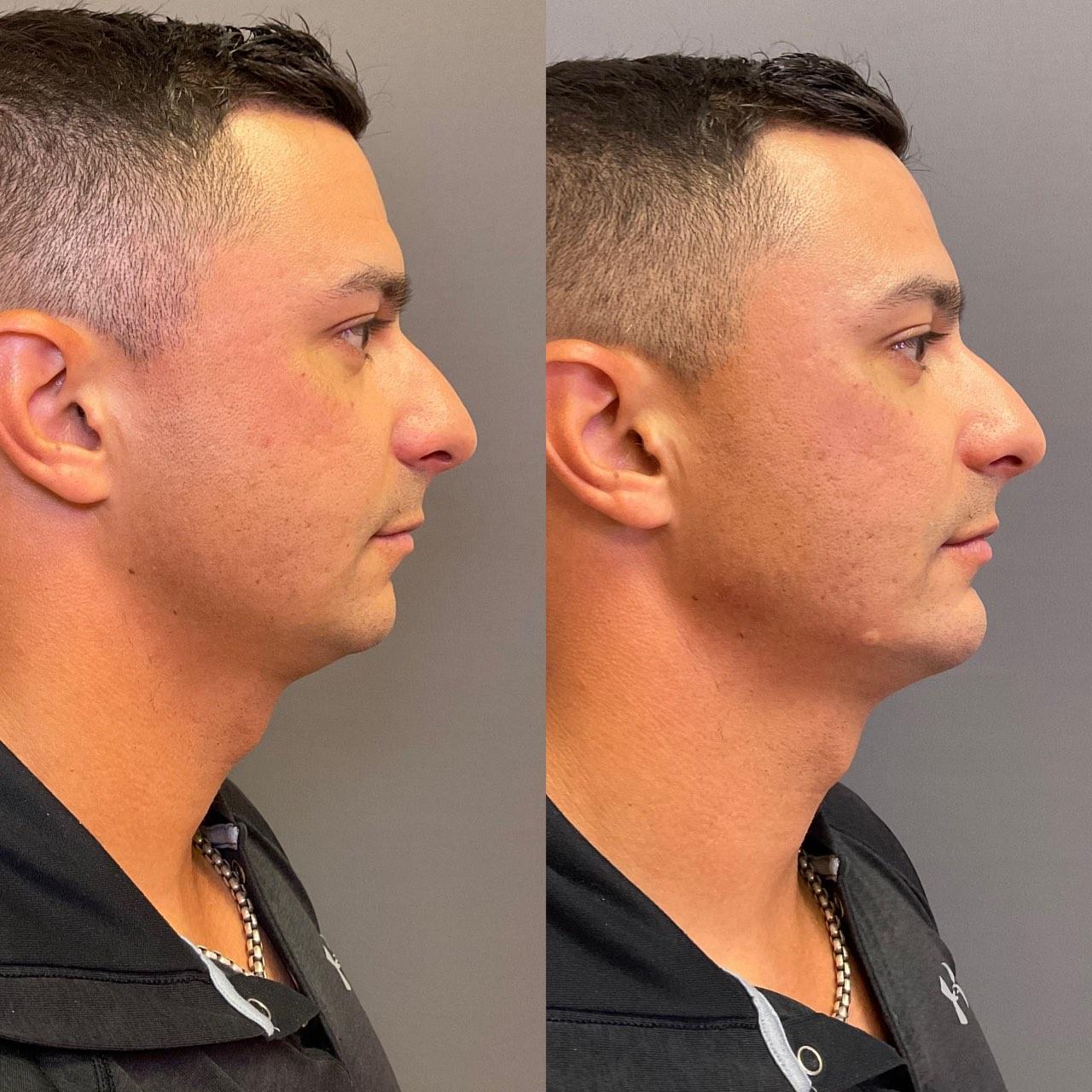 Before and after photo of a NuGen patient — Facial balancing