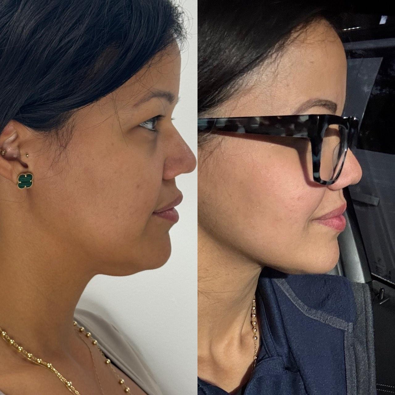 Before and after photo of a NuGen patient — Facial balancing