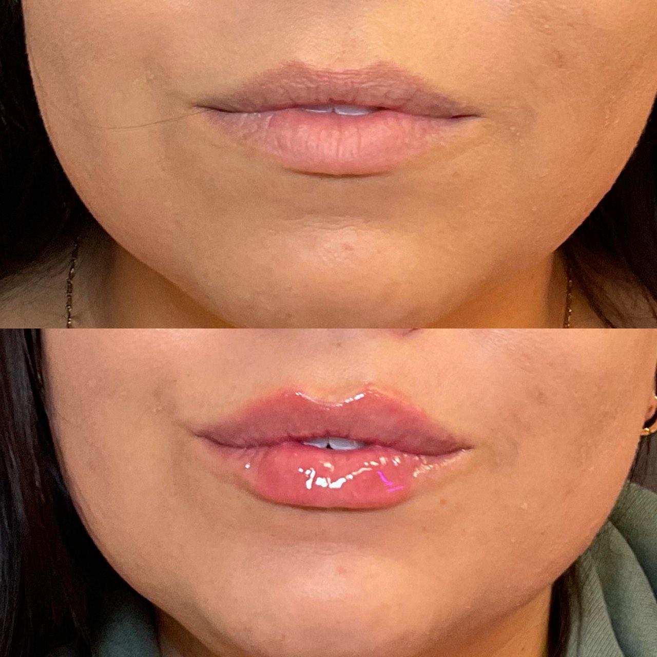 Before and after photo of a NuGen patient — Lip enhancement