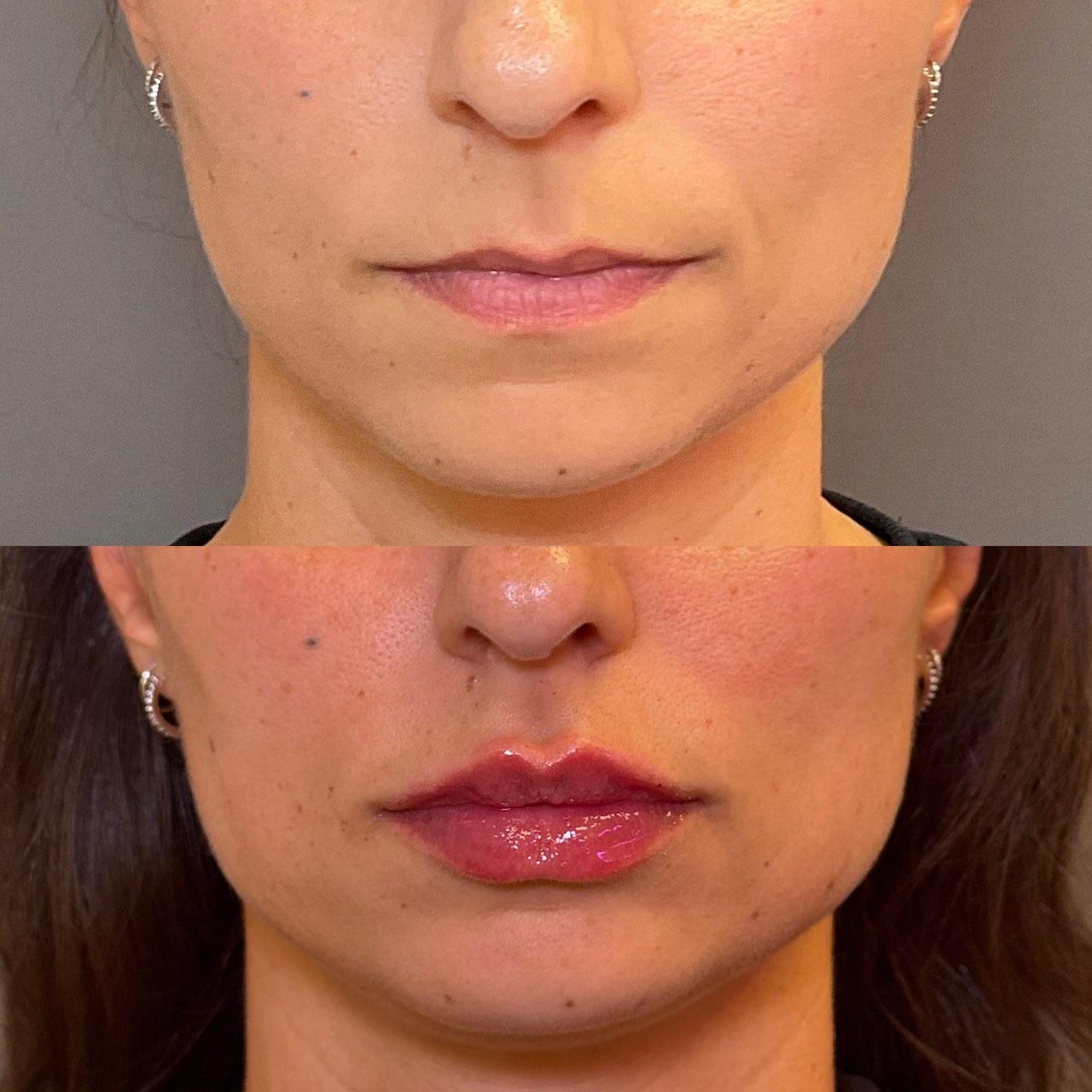 Before and after photo of a NuGen patient — Lip enhancement
