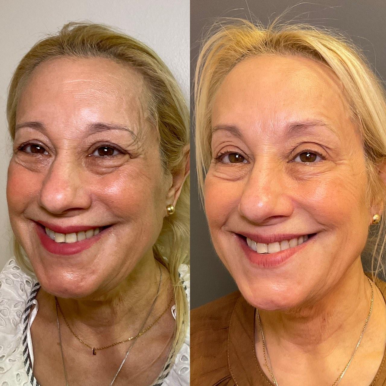 Before and after photo of a NuGen patient — Skin & texture