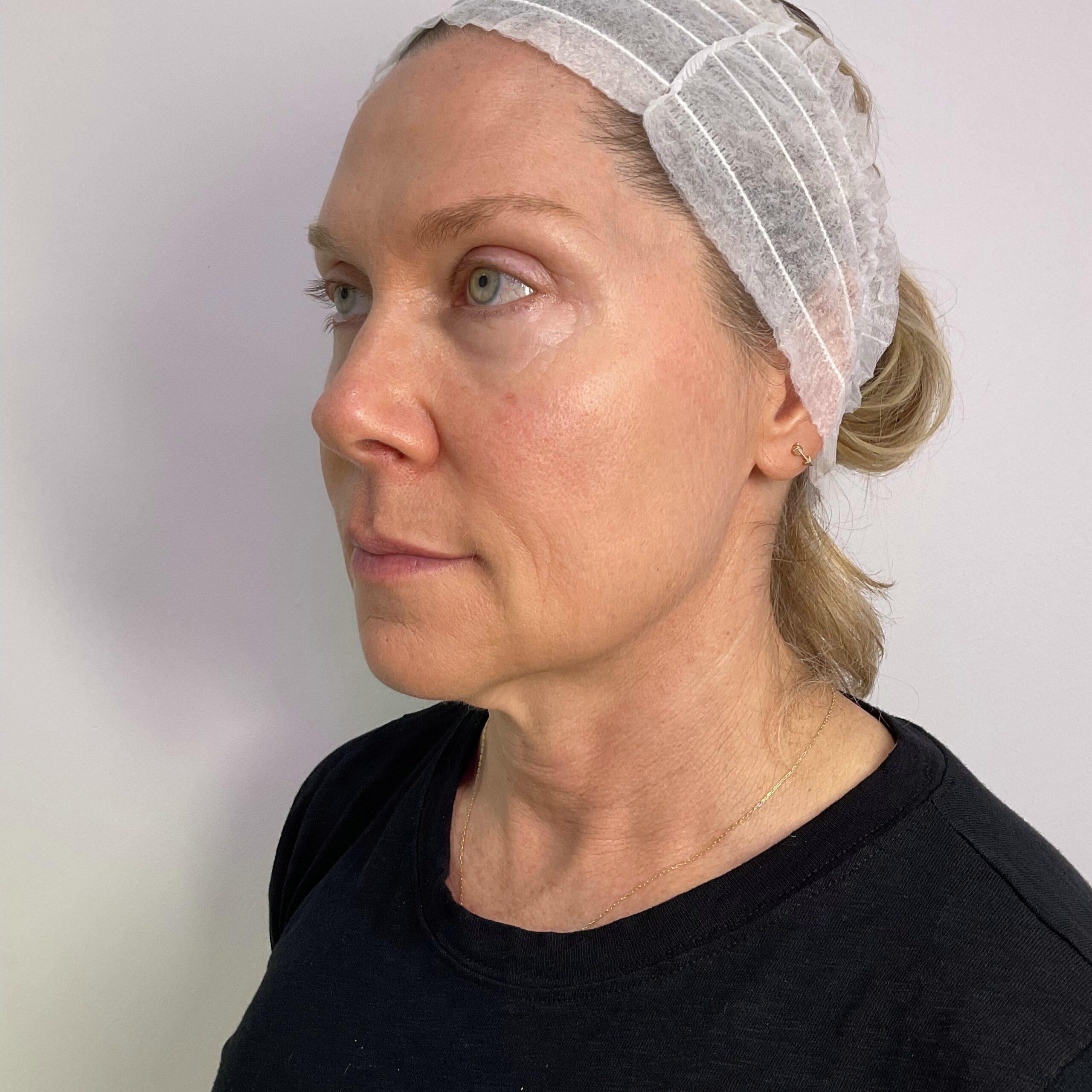 Before and after photo of a NuGen patient