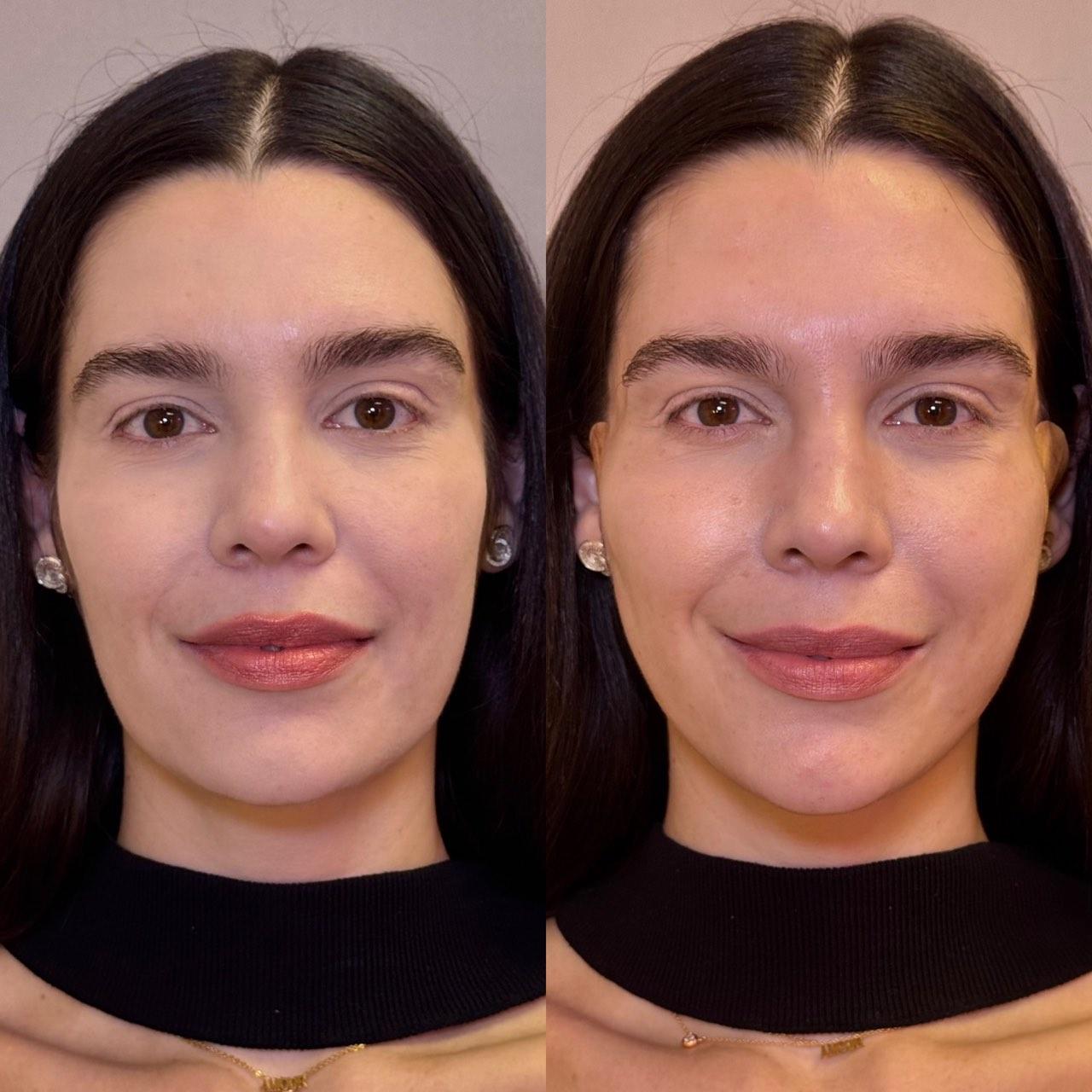Before and after photo of a NuGen patient — Facial balancing